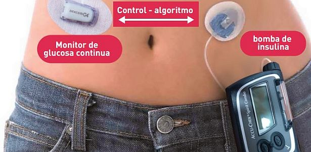 pancreas artificial